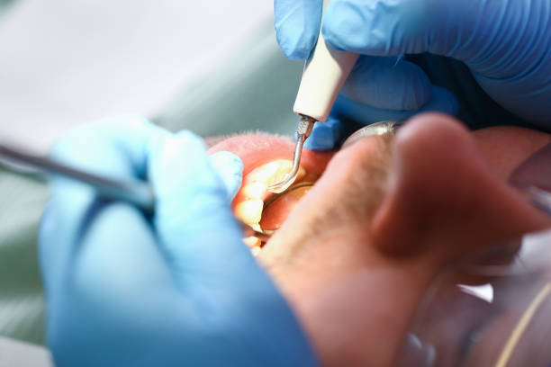 Best Emergency Wisdom Teeth Removal in Cambridge, MD