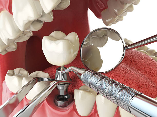 Best Emergency Treatment for Dental Infections or Abscesses in Cambridge, MD