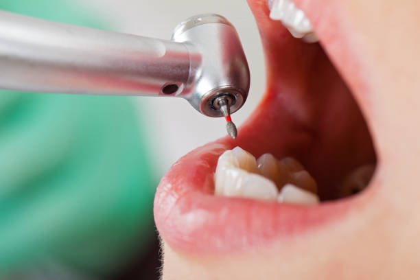 Best Emergency Gum Treatment in Cambridge, MD